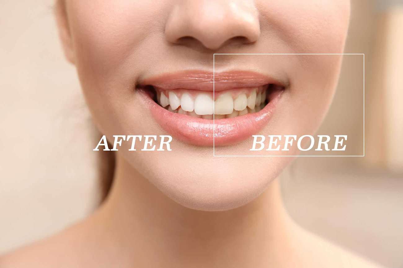 How Can You Maintain a Consistent Smile Shade with Crowns Aylesbury?