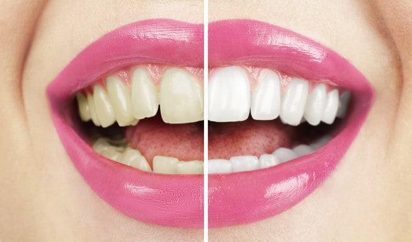 What Makes Ultima White Teeth Whitening Different Aylesbury