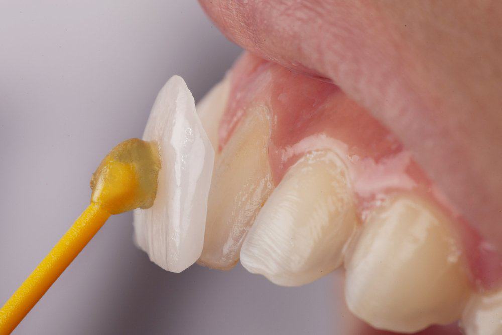 Dental Veneers: Achieving a Flawless Look Aylesbury