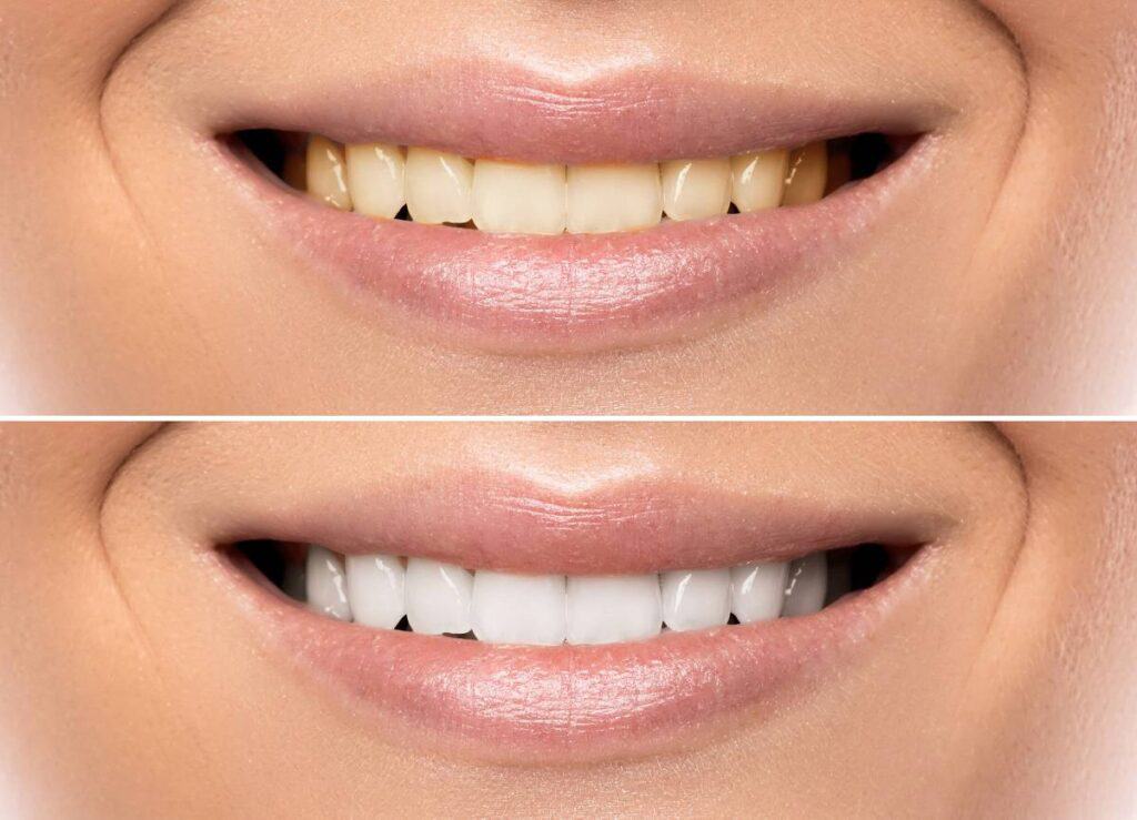 How Does Gum Disease Progress if Left Untreated Aylesbury?