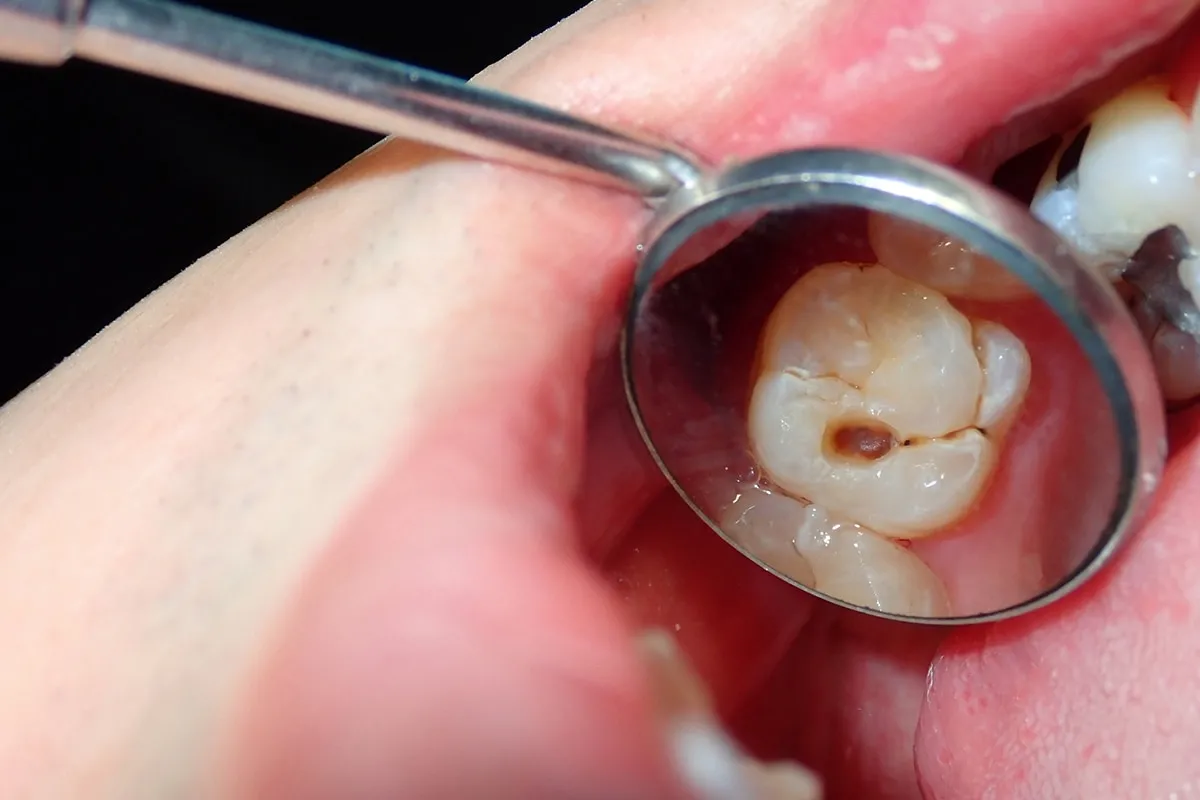 Why Do Teeth Crack? Common Causes to Know Aylesbury