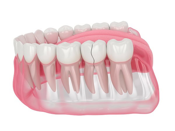 How Can You Manage Pain and Discomfort After a Root Canal Aylesbury?