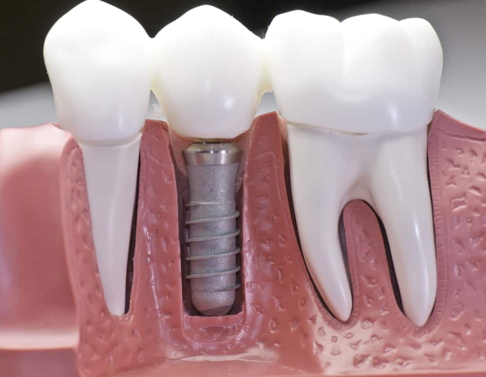Common Misconceptions About Modern Dental Treatments Aylesbury