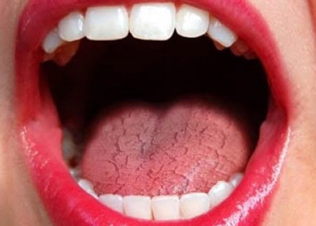 Dry Mouth and Its Role in Tooth Decay Aylesbury