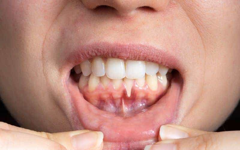 How Can Gum Disease Be Prevented Aylesbury?