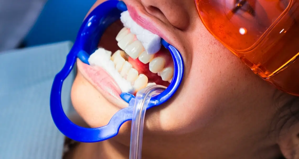 What Side Effects Can You Experience After Laser Teeth Whitening Aylesbury?