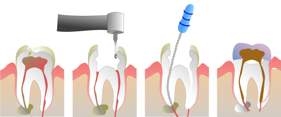 How Do You Properly Care for Your Teeth After a Root Canal Aylesbury