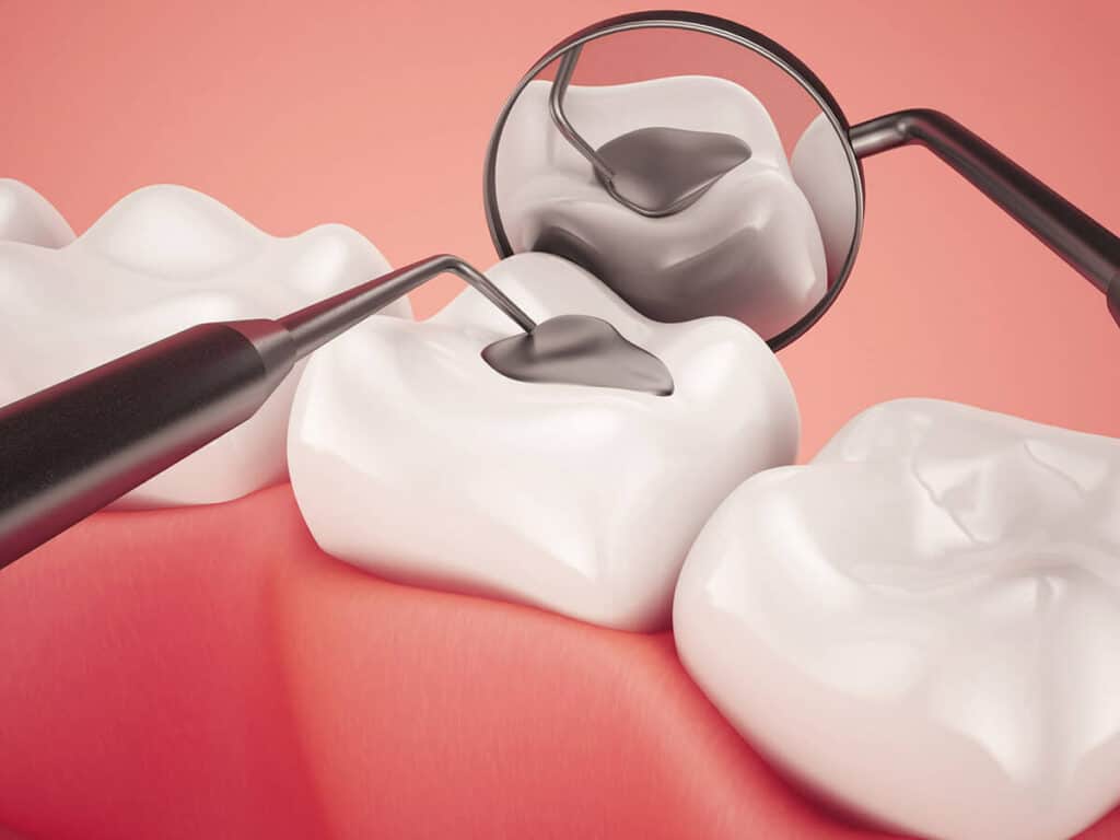 Fighting Cavities and Plaque Buildup Aylesbury