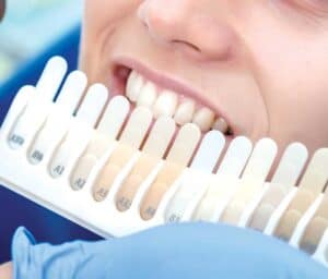 Ultimate Guide to Teeth Whitening with Natural Ingredients Aylesbury