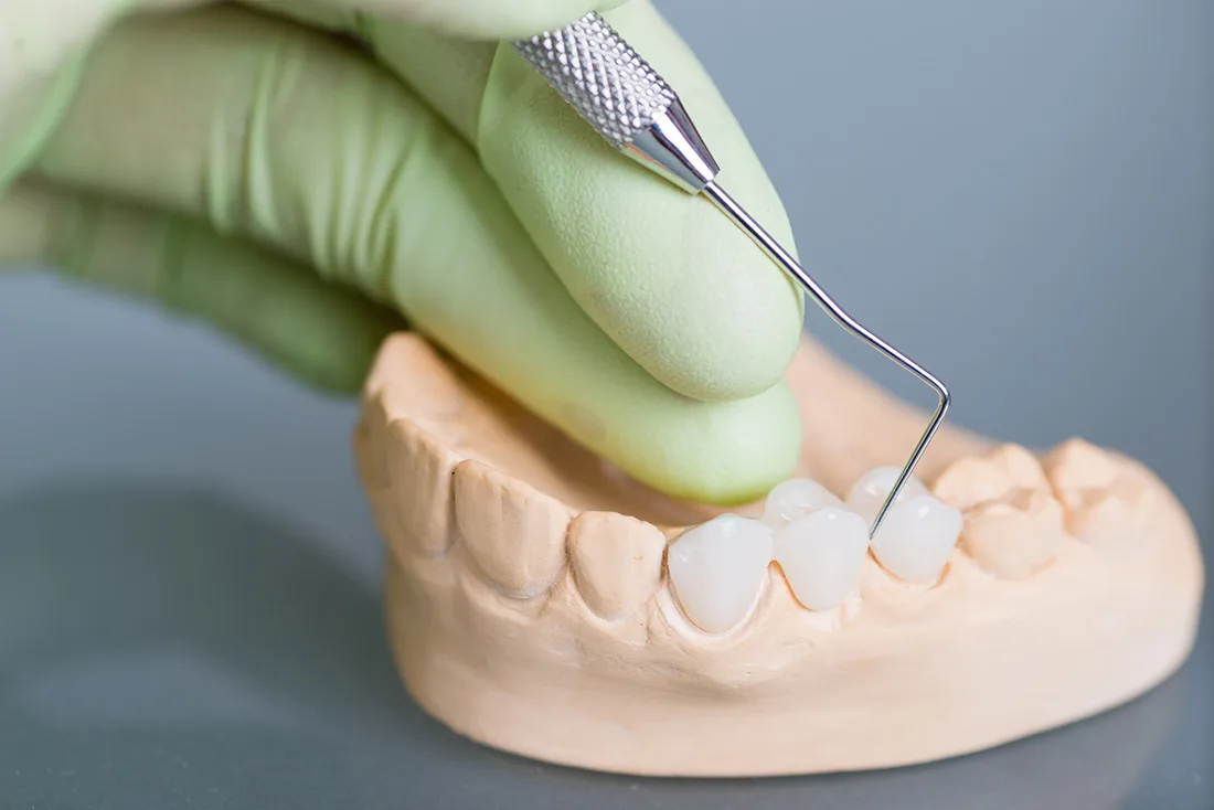 Do Braces Take Years to Show Results Aylesbury