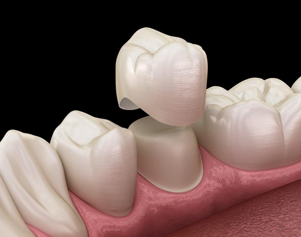Teeth Whitening: Separating Facts from Fiction Aylesbury