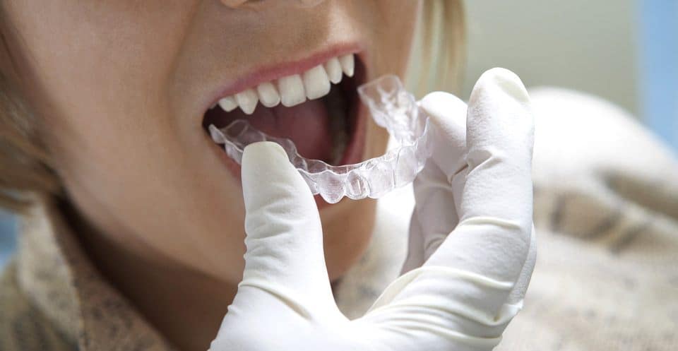 Why Bleaching Trays Require More Time Aylesbury